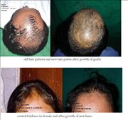 Before After Pictures,Cosmetic & plastic Surgery,Delhi,hair transplant 
